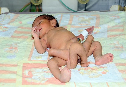 Pakistan doctors fight to save life of baby with six legs