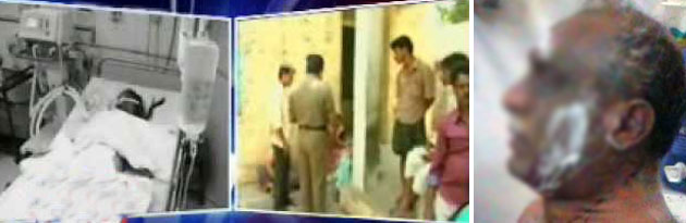 Wife Acid Attack on Husband in Kurnool