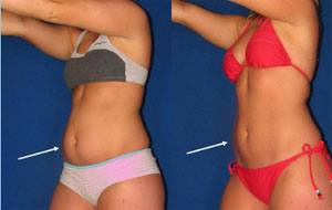 Liposuction-treatment