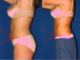 Liposuction-treatment1