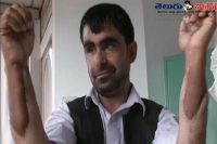 Afghanistan citizen got hands by transpalntation in india