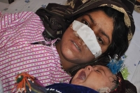 A woman in afghanistan has had her nose cut off by her husband