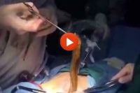 Eel out of a patient s body after he stuck it up his bum