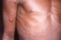 Samples of 5 year old up girl collected for suspected monkeypox