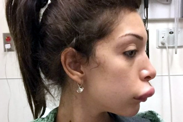 Farrah abraham lip implant surgery problems